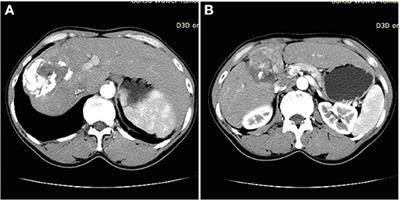 Hepatocellular Carcinoma Complicated by Echinococcal Cyst: A Case Report